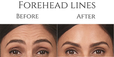 Botox Before & After Forehead Lines