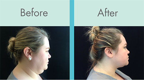Coolsculpting before and after chin
