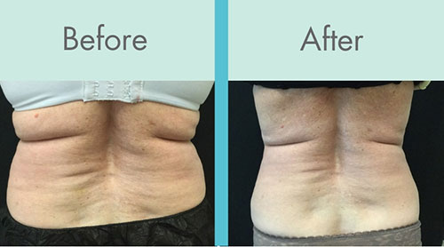 Coolsculpting before and after stomach
