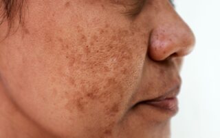 Brown spots on skin