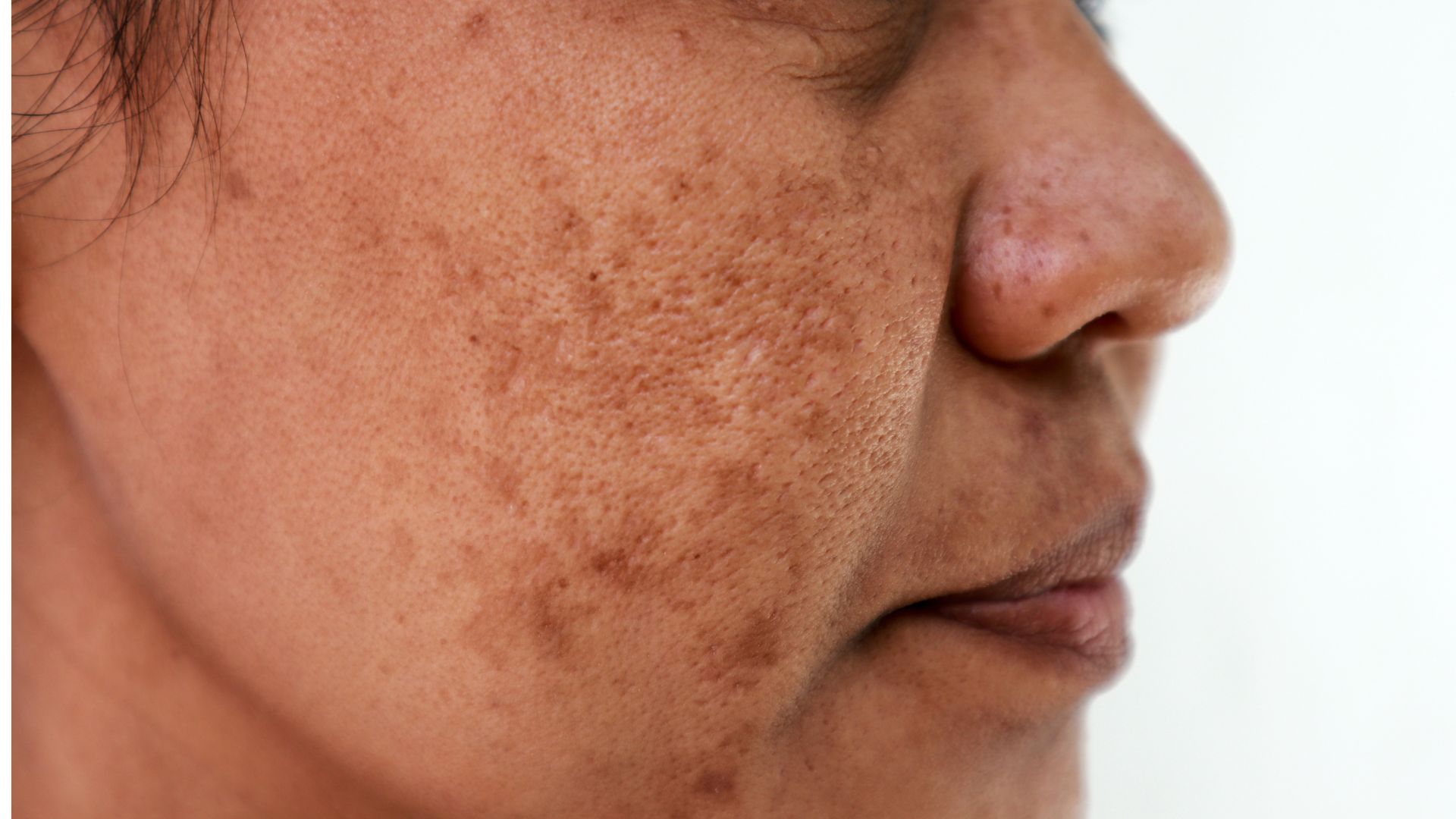Brown spots on skin