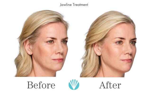 Juvederm Volux Before and After