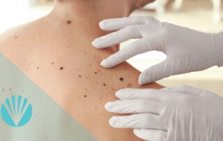 Male Skin Cancer Check